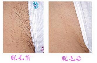 比基尼脱毛后的效果怎么样
